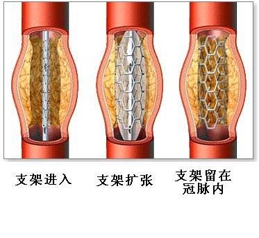 心脏支架最早出现在20世纪80年代,经历了金属支架,镀膜支架,可溶性