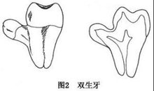 双牙畸形