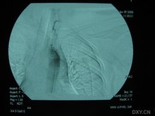 颅内肉芽肿性动脉炎