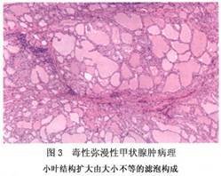 甲状腺弥漫性病变