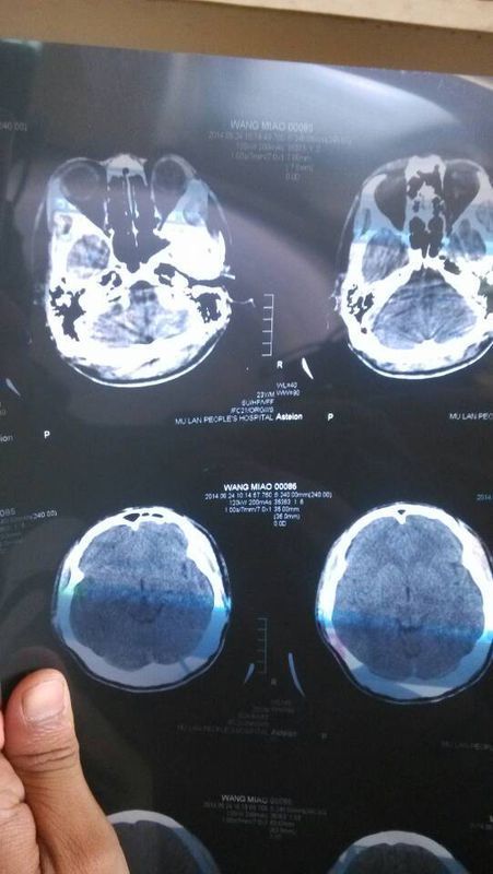 哪个大夫可以给我看看这个脑部CT的片子,我偏