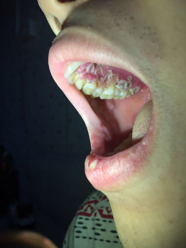 扁桃体发炎 发烧三天 淋巴结肿大 去医院看大夫