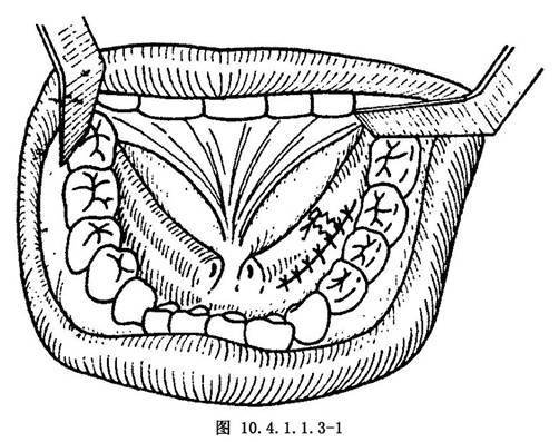 舌下腺(sublingual gland 较小,扁长圆形,位于底舌下襞的深面,导管有