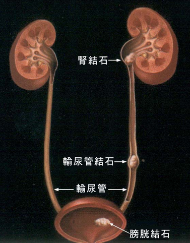 肾结石