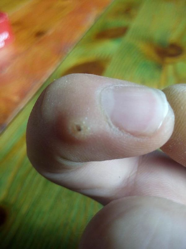 右手食指 长了一个包 有一两年了,现在越来越大